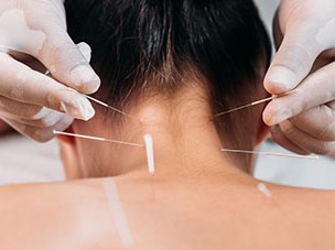dry needling physical therapy practices