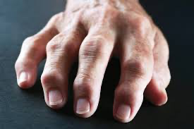 arthritis can be painful, find out ways to help manage the pain without medication 